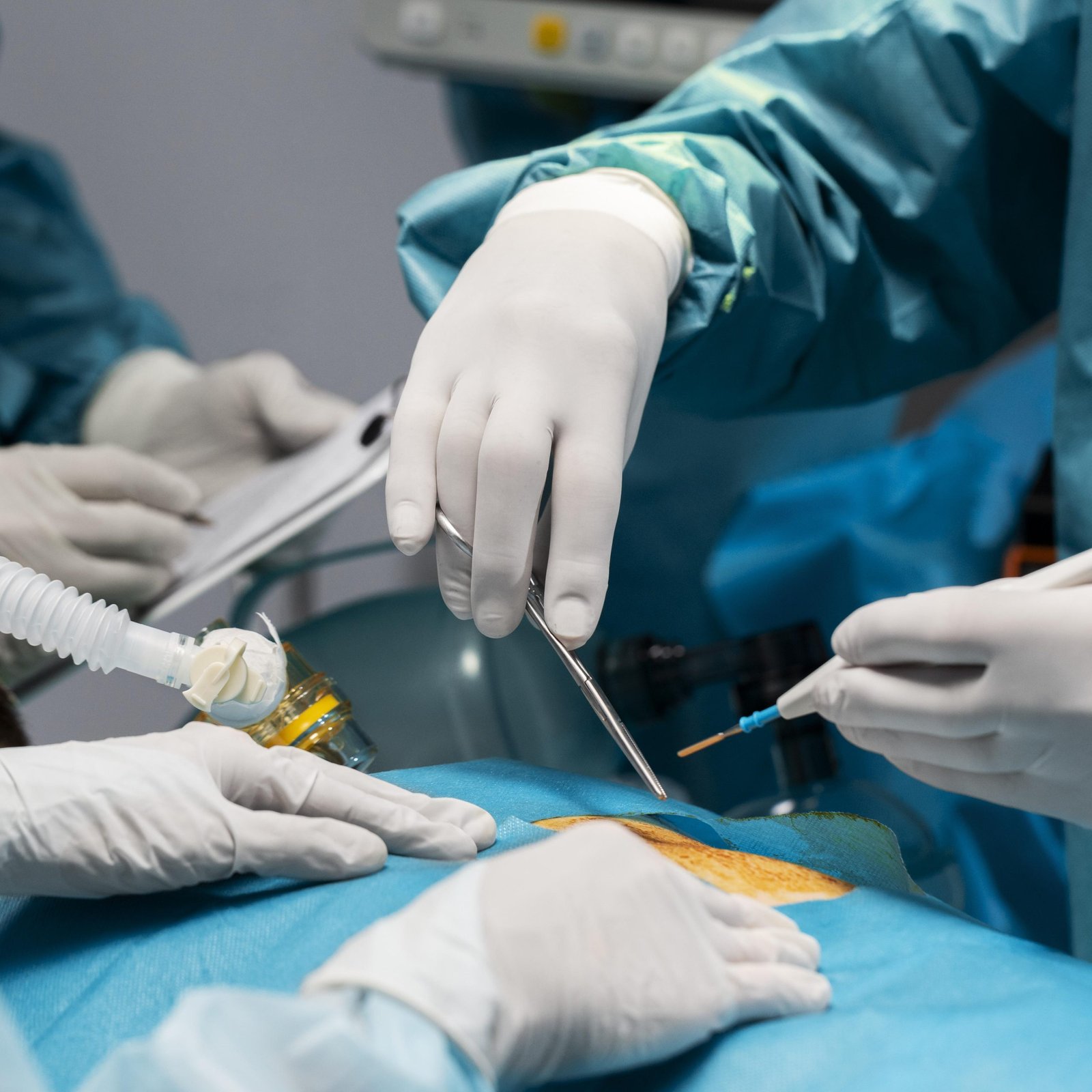 Best gallbladder Stone Surgery In Faridabad